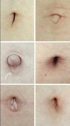 What is Umbilical Hernia?? How does it look like?? #healthmedia