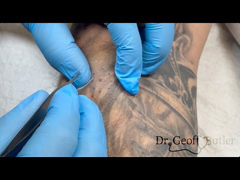 Removal of a calcified cyst