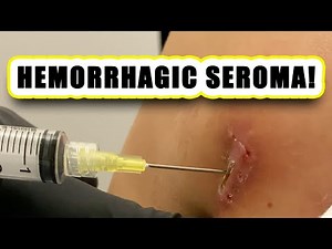 HEMORRHAGIC SEROMA!