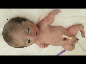 What are the causes of thanatophoric dwarfism? mutation in GFR3 gene, autosomal dominant,