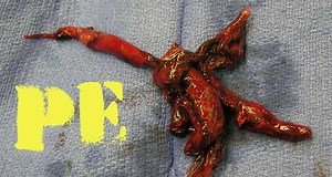 EMCrit 143 - Hemodynamic Management of Massive Pulmonary Embolism (PE)