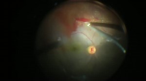 Reoperation for Incomplete Hyaloid Removal After Initial Diabetic Vitrectomy - Eyetube