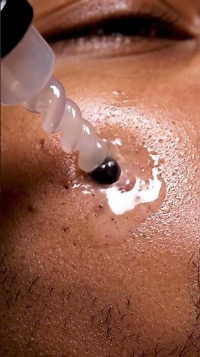 Blackhead Removal: Nose & Forehead Extraction with Comedone Tool