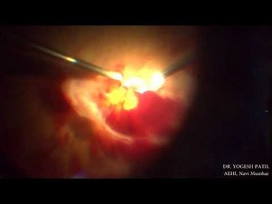 Diabetic Retinopathy Treatment-Vitrectomy Surgery by Dr. Yogesh Patil, AEHI, Navi Mumbai