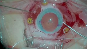 Dislocated IOL - Eyetube