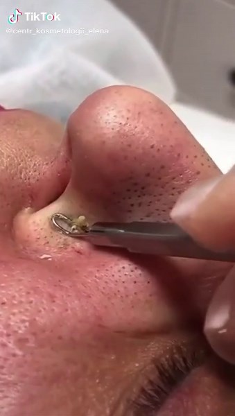 Effective Nose Cleaning Techniques Using Metal Tools