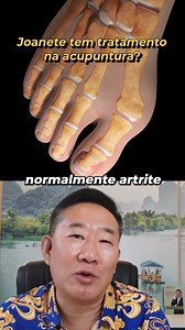É importante saber o que é o Joanete, porque ele se forma e como você pode tratar dele! A acupuntura é uma das formas de tratamento que podem auxiliar a aliviar sua dor! Comente se já sabia! #acupuntura #joanete #tratamento #saúde #medicinachinesa | Dr Peter Liu - Medicina Oriental