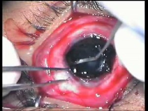 evisceration eye surgery - Vision Eye Centre