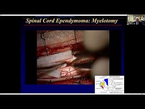 Nuances in the Care of Spinal Cord Ependymoma - Mark E. Shaffrey, M.D.