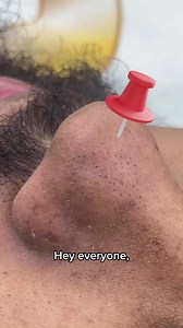 2.6K views · 11 reactions | These nose dots , also known as...