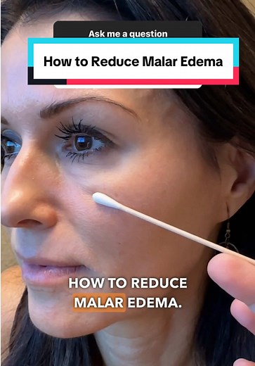 Tips to Effectively Reduce Malar Edema