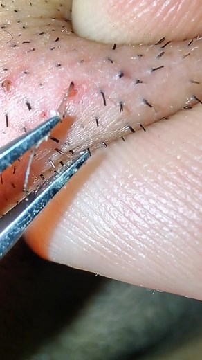 Effective Ingrown Hair Removal Techniques for Beard Using Tweezers