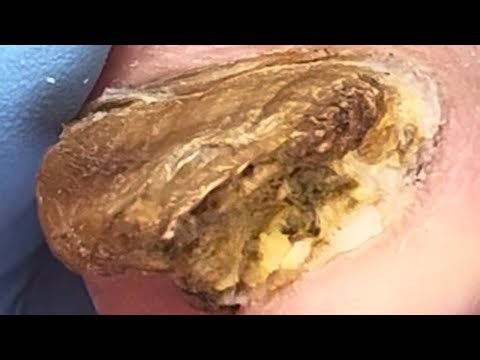 Onychomycosis Is Extremely Prominent, Cut Off The Fungus!【Podiatry Clinic】