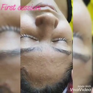14K views · 136 reactions | Acne treatment facial First session going on hot line : 01675704420 | Keya Sheikh's Makeover Salon | Facebook