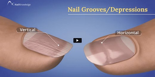 Nail Grooves / Depressions - NailKnowledge