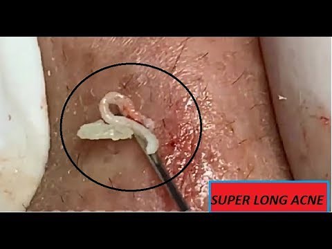 Whiteheads super Long, big Blackeads 12 | Loan Nguyen