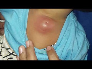 Sebaceous Cyst Punctum