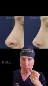 Revision rhinoplasty to treat alar retraction