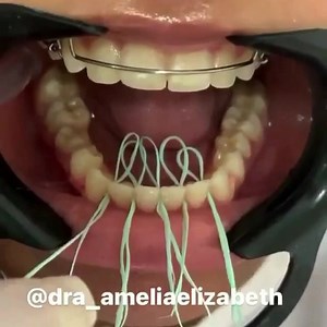Placing a lingual retainer 🦷 #ortho #hack #dentistry #smile . . By @dra_ameliaelizabeth | Dentistry blog