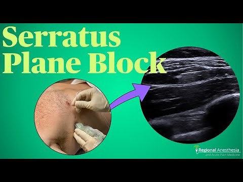 Serratus Plane Block