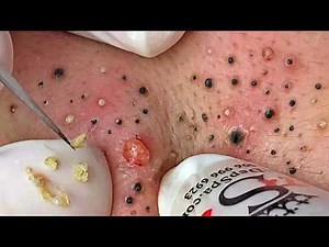 Blackhead Removal With Sac Dep Spa @762