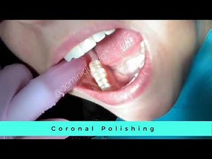 Tips on Coronal Polishing