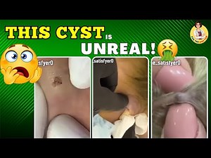 The Most Extreme Ingrown Hairs & Cysts You’ll Ever See