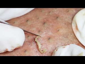 Daily Video Relaxing with Sophia Skin Care, Acne, Whiteheads & Blackheads #058