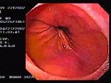 Hiatus Hernia with Schatzki Ring • Video • MEDtube.net