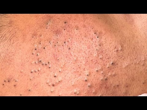 Ultimate Beauty Routine For Blackheads And Pimples — Facial Cleansing Techniques