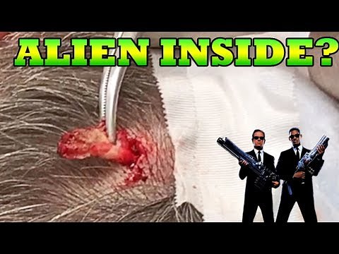 Alien Scalp Cyst - What’s Inside?Cysts & Pimple Pops