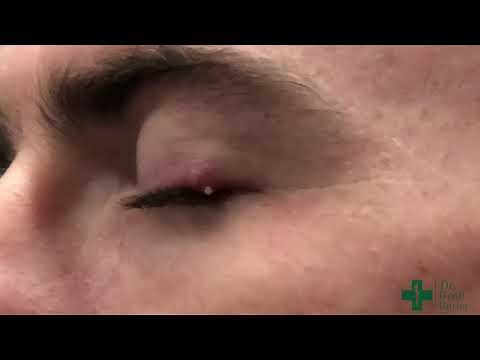 Puncturing a Small Stye or Cyst along the Eyelid Margin