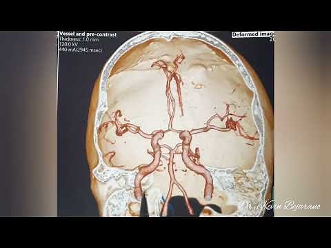 ANGIOTOMOGRAFIA DE VASOS CEREBRALES EN RECONSTRUCCION EN 3D PARA INTRODUCCIÓN SEGUNDA PARTE PARTE