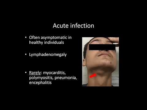 Ocular Toxoplasmosis: Dr.João M. Furtado