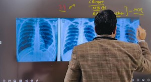 Though Rare but Can be MDR TB in Pleural Effusion - Pulmo Kranti | Meerut to India #MDRT #tbt #pulmonologist #doctor | Harendra Kumar