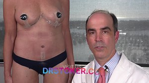 Restoring Confidence: A Comprehensive Breast Lift Transformation