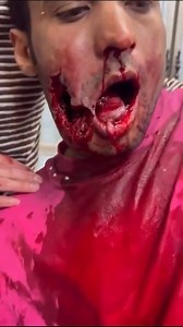 Nasty jaw injury from workplace accident • GoreCenter