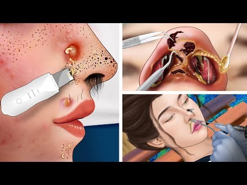 ASMR Treatment and Removal Nasal piercing cleaning, sebum extrusion, sinusitis, dry eyelids, braces