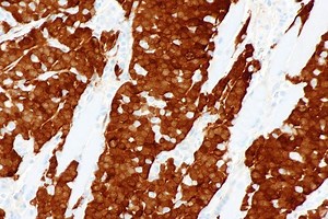 Head and neck squamous cell carcinoma - Alchetron, the free social encyclopedia