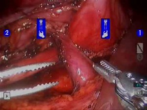Right Robotic Pyeloplasty