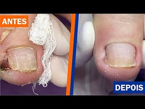 UMA SEMANA E PONTO FINAL (antes e depois) [Renata Werneck Podóloga - Unha Encravada]