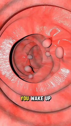 Understanding Irritable Bowel syndrome (IBS): Causes, Symptoms & Treatment #ibs #irritablebowelsyndrome | PurelyFit