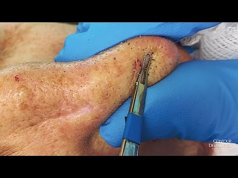 Full Face Blackheads Extraction (Open Comedones) | CONTOUR DERMATOLOGY