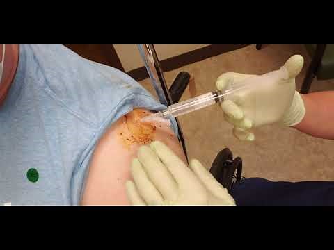 Cortisone Injection to the Shoulder