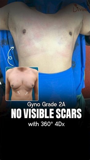 Grade 2A Gynecomastia Transformation | 360° 4Dx Scarless Chest Sculpting