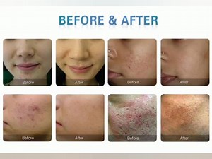 #secret_RF_micro_needle  يستعمل الجهاز في معالجة العديد من المشاكل...