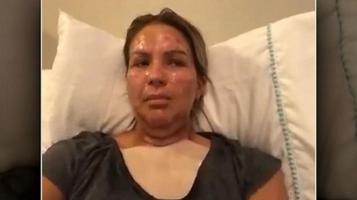 Mom speaks out after hand sanitizer goes up in flames, leaving her with burns