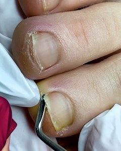 15K views · 15 reactions | Curled toe nails treated by a professional! | Rush Brush | Facebook