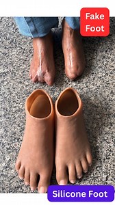 Bilateral Silicone Foot Prosthesis | Silicone Artificial Foot India | Cosmetic & Comfortable Solution Losing both feet does not mean losing confidence, mobility, or independence. In this video, we share a real-life journey of a patient who was fitted with a Bilateral Silicone Foot Prosthesis at Ideal Artificial Limbs Solution, Delhi. This advanced silicone artificial foot is specially designed for patients who have undergone bilateral foot amputation and are looking for a cosmetic, comfortable,