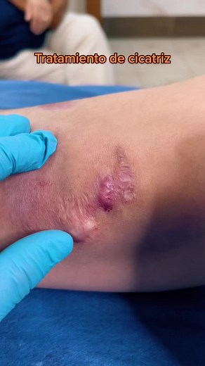 Advanced Wound Healing Techniques Revealed